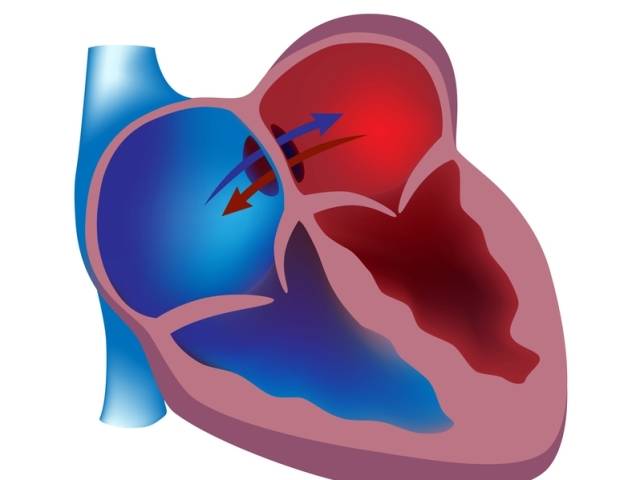 Информационный лист пациента | эндоваскулярное лечение врожденных пороков сердца в институте амосова