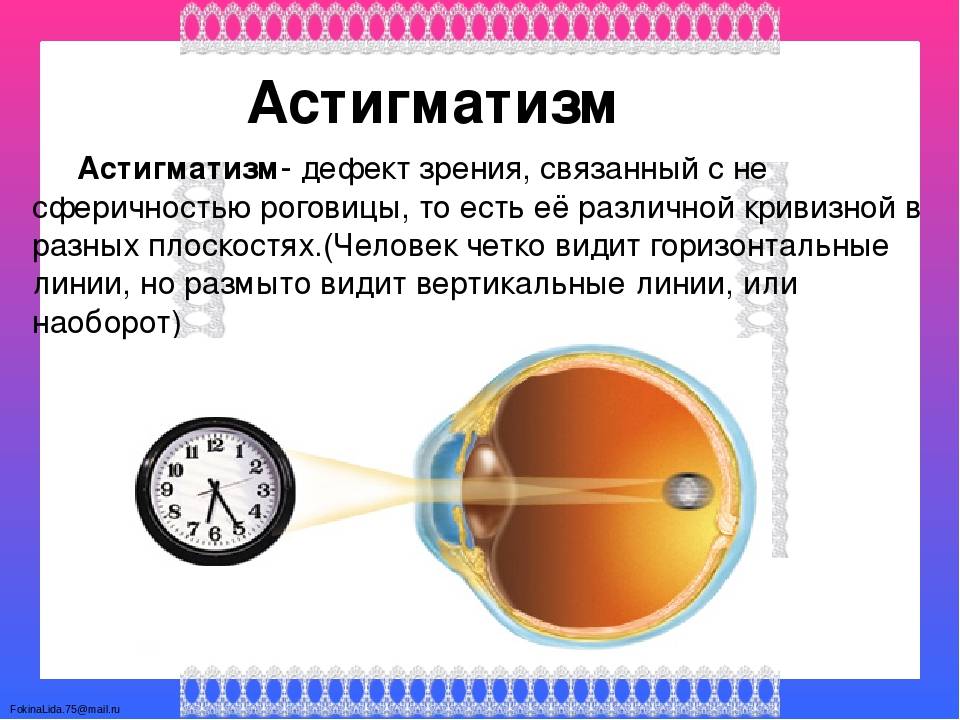 Близорукость дальнозоркость астигматизм презентация