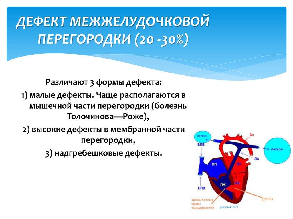 Дефект межжелудочковой перегородки презентация