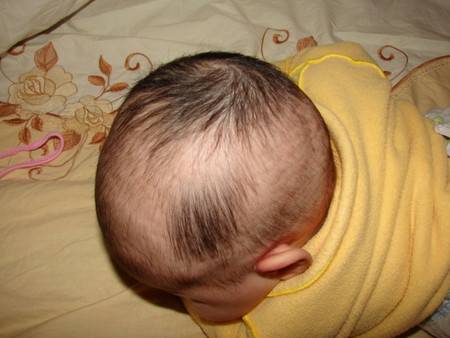 Причины облысения затылка младенца: почему стираются волосы у новорожденного