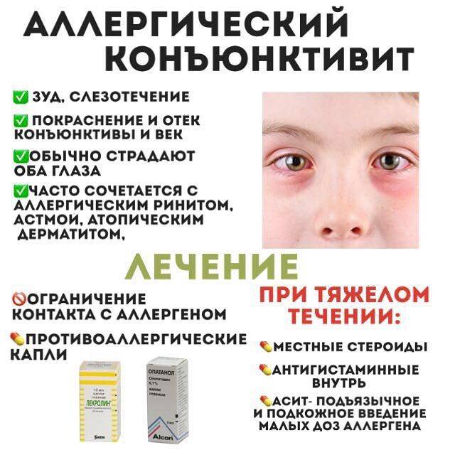 Аллергический конъюнктивит у детей и взрослых: симптомы, лечение — online-diagnos.ru