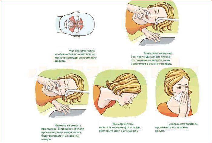 Не вытекает из носа при промывании. Как правильно промывать нос раствором с шприцом. Как правильно промывать нос солевым раствором из спринцовки. Как промыть нос солевым раствором из шприца ребенку. Как правильно промывать нос солевым раствором из шприца в домашних.