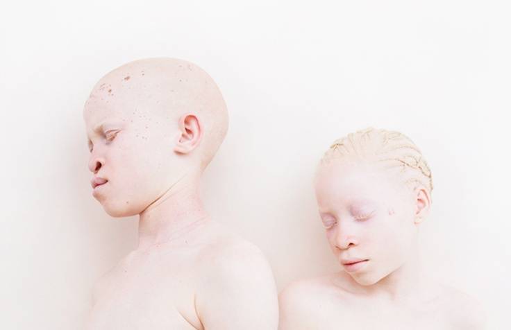 Кто такие альбиносы и почему. «белая ворона», или особенности здоровья и развития ребенка-альбиноса. передается ли по наследству альбинизм