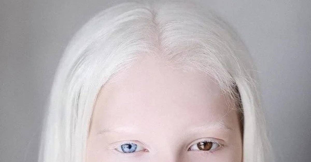 Люди альбиносы: особенность и возможные последствия