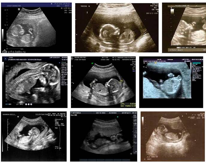 15 неделя беременности. календарь беременности   | материнство - беременность, роды, питание, воспитание