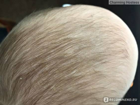 Корочка на голове у грудничка: причины чешуек у новорожденного ребенка, масло, шампунь, крем, гель и другие средства для лечения желтых корочек