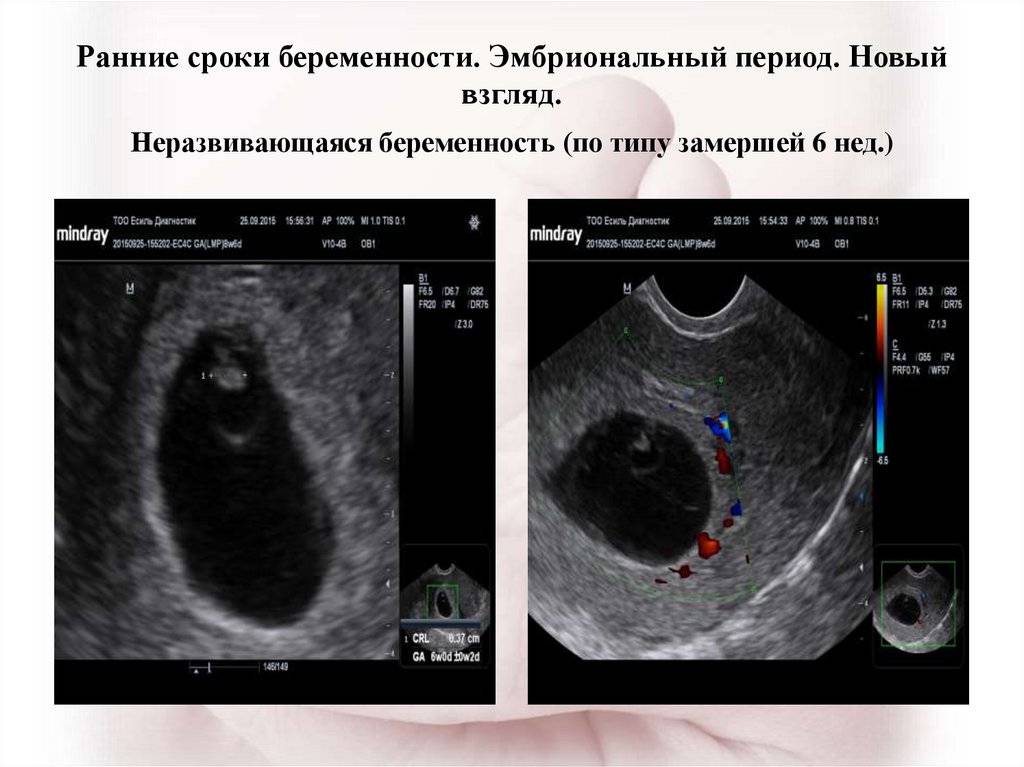 Замершая беременность: признаки, причины – замирание беременности на ранних сроках  — медицинский женский центр в москве