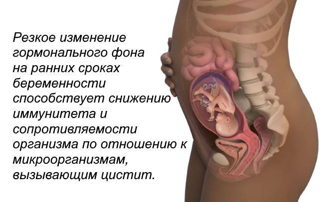 Лечение цистита на ранних сроках беременности в клинике семейный доктор
