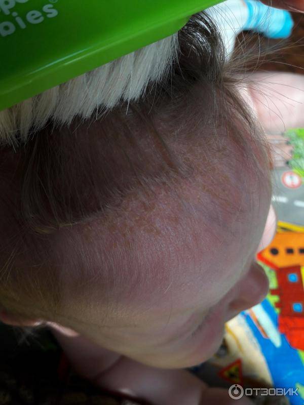 Как вычесать корочку на голове у ребенка с длинными волосами