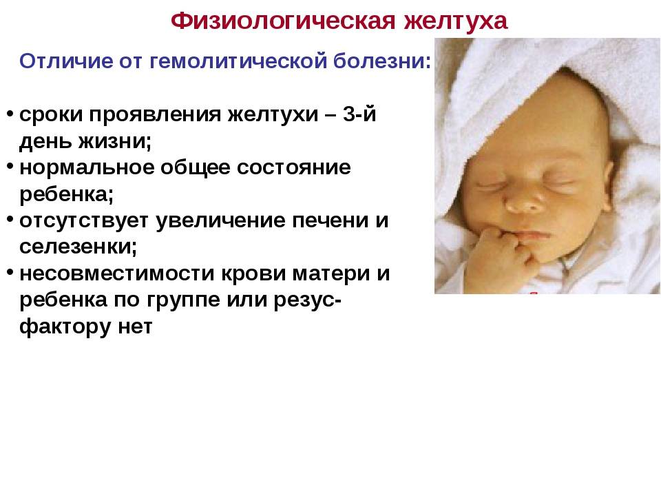 Причины и последствия желтухи у новорожденных, когда должна пройти