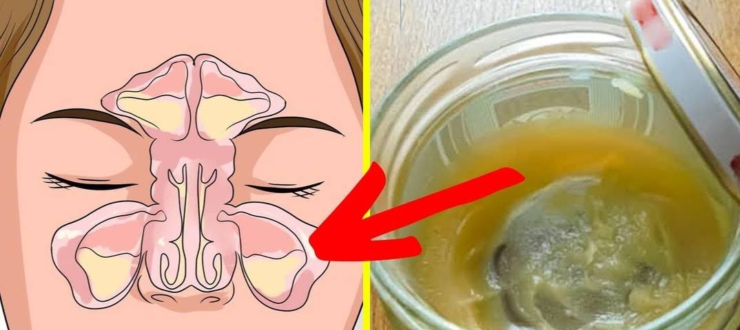 Можно ли вылечить насморк быстро? 7 советов оториноларинголога