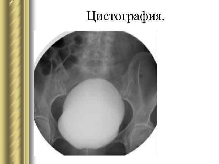Микционная цистография мочевого пузыря в москве, проведение цистографии в клинике цэлт