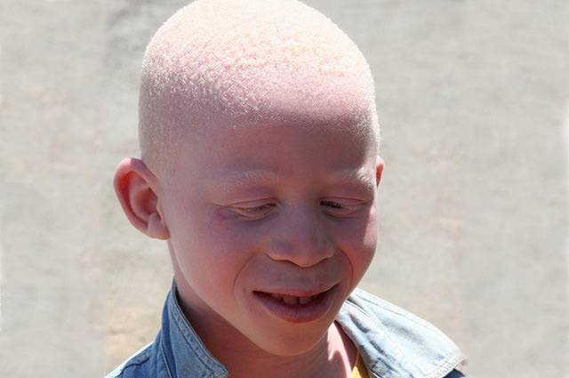 Альбинизм: причины, виды, лечение, генетические факторы