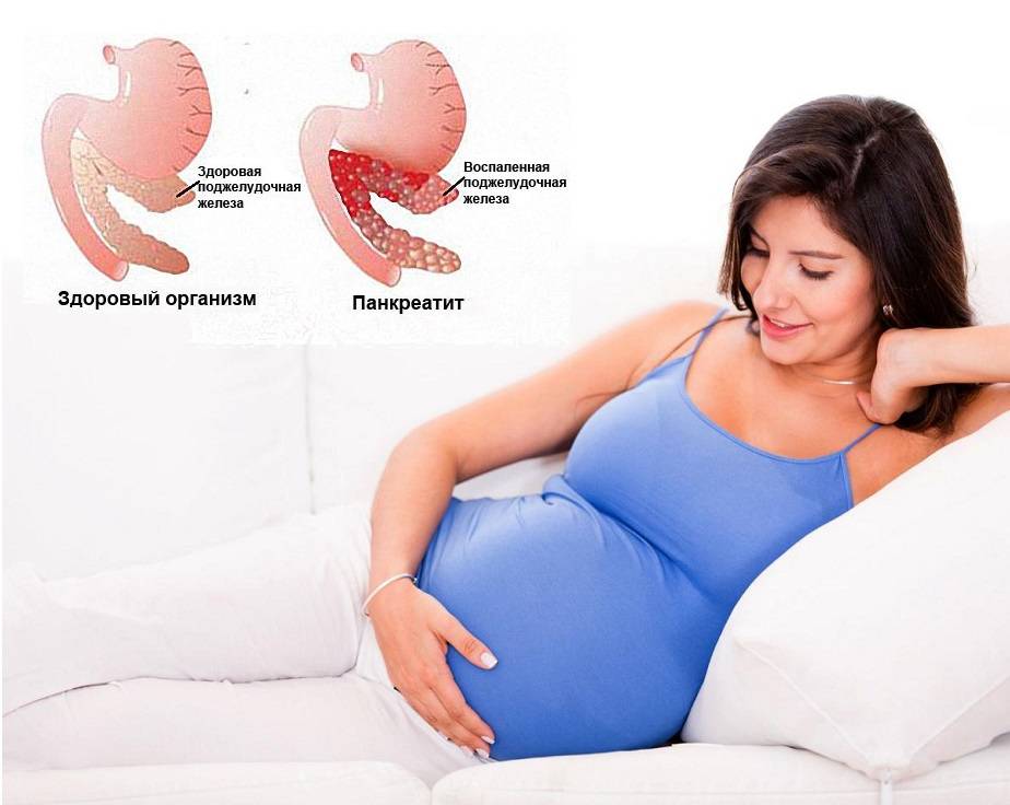 Как справиться с панкреатитом при беременности