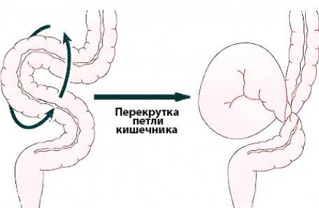 Долихосигма кишечника что это такое у взрослых симптомы лечение фото