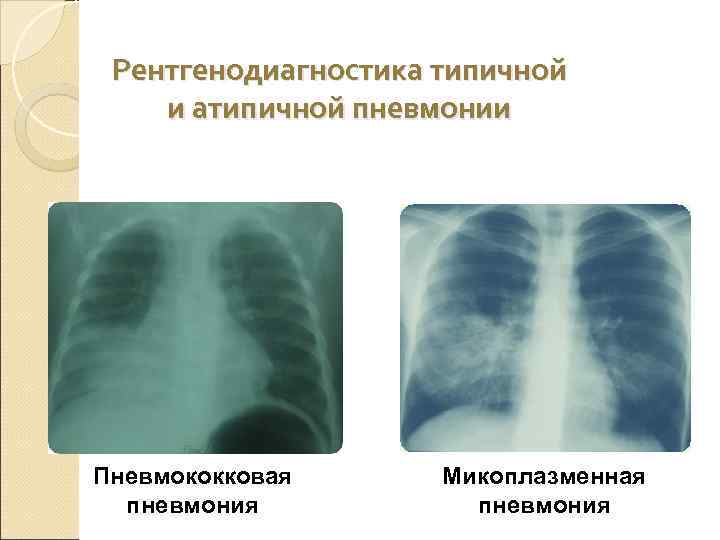Микоплазменная инфекция дыхательных путей у детей. признаки и лечение