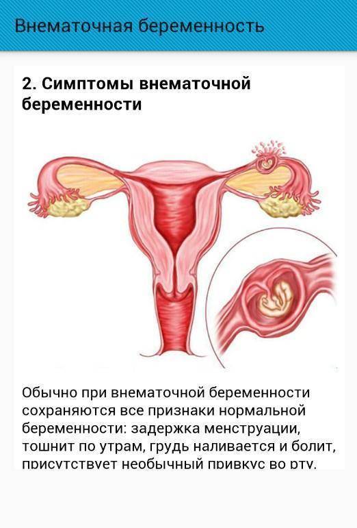 Клиническая больница | внематочная беременность
