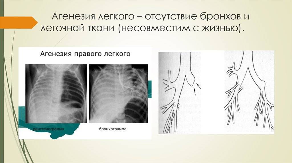 Отсутствуют ткани. Агенезия (аплазия) бронхов. Агенезия и аплазия легкого. Агенезия аплазия легких. Агенезия аплазия гипоплазия легких.