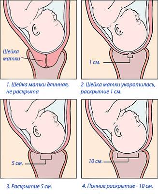 Сравнительная оценка механических способов подготовки шейки матки к родам у беременных с экстра­генитальными заболеваниями