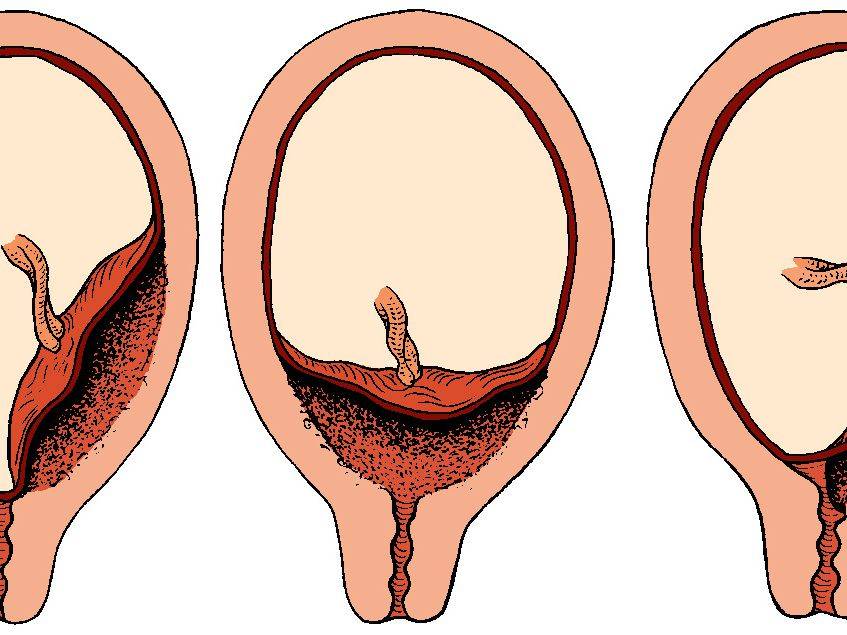 Полное предлежание при беременности. Предлежание плаценты при беременности. Предлежание плаценты хориона. Боковое предлежание плаценты. Частичное предлежание плаценты.