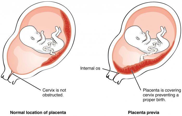 Предлежание плаценты при беременности: причины, симптомы, диагностика и лечение