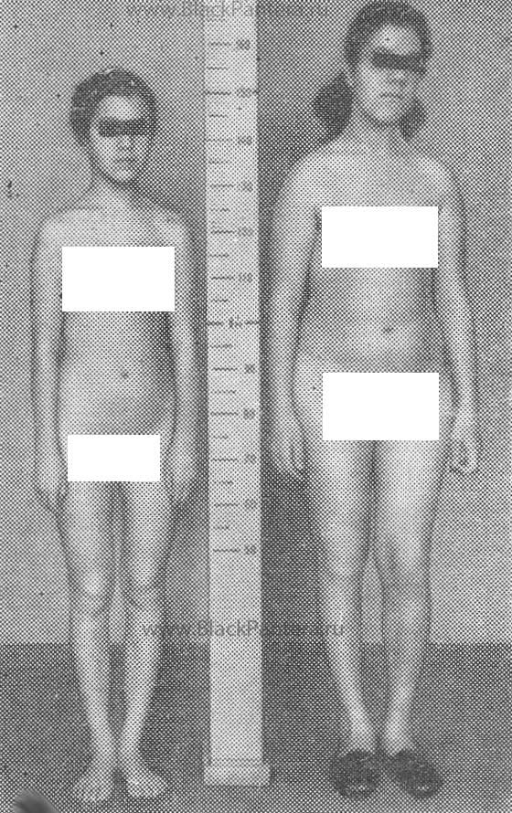 Пубертатный период (телархе, пубархе, менархе) | eurolab | гинекология