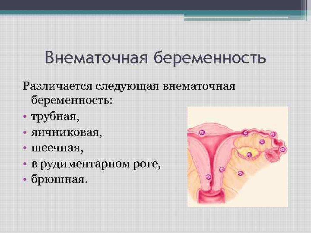 Первые симптомы внематочной беременности: как определить на ранних сроках