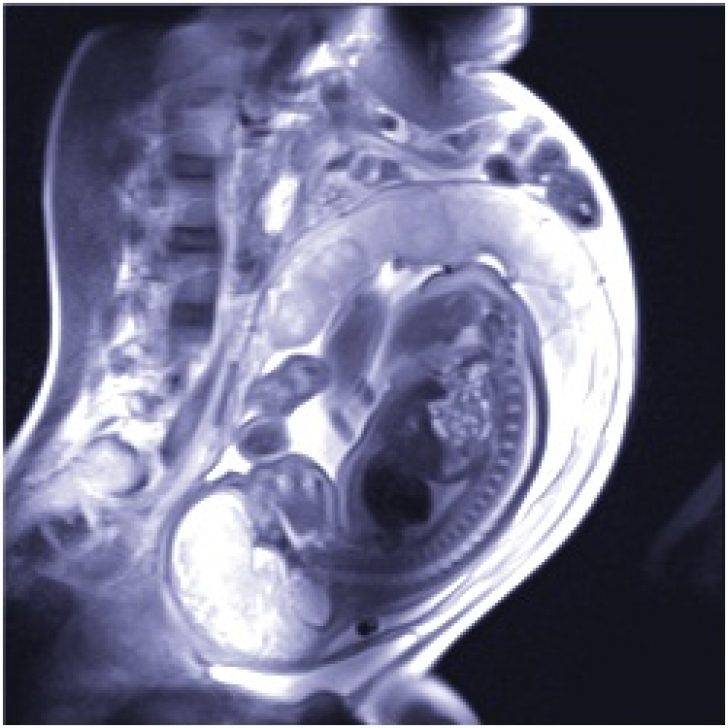 Опасность рентгена при беременности - рентген легких, зуба, носа на раннем и позднем сроке беременности
